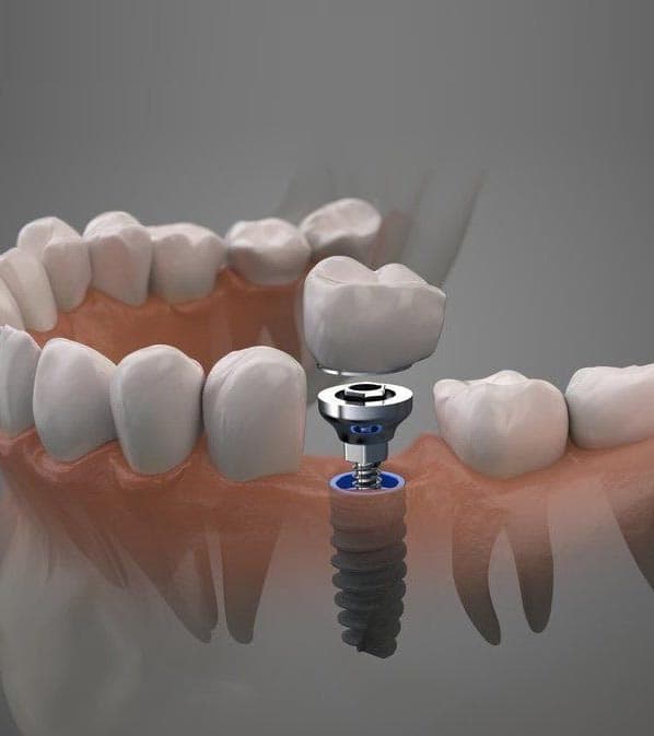 Types of dental implants