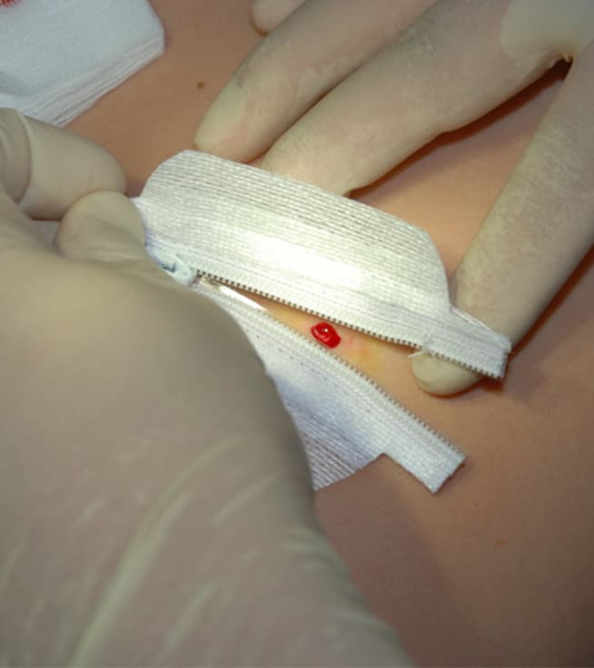 Cutaneous Wound Closure Materials: Focus on Surgical Zippers