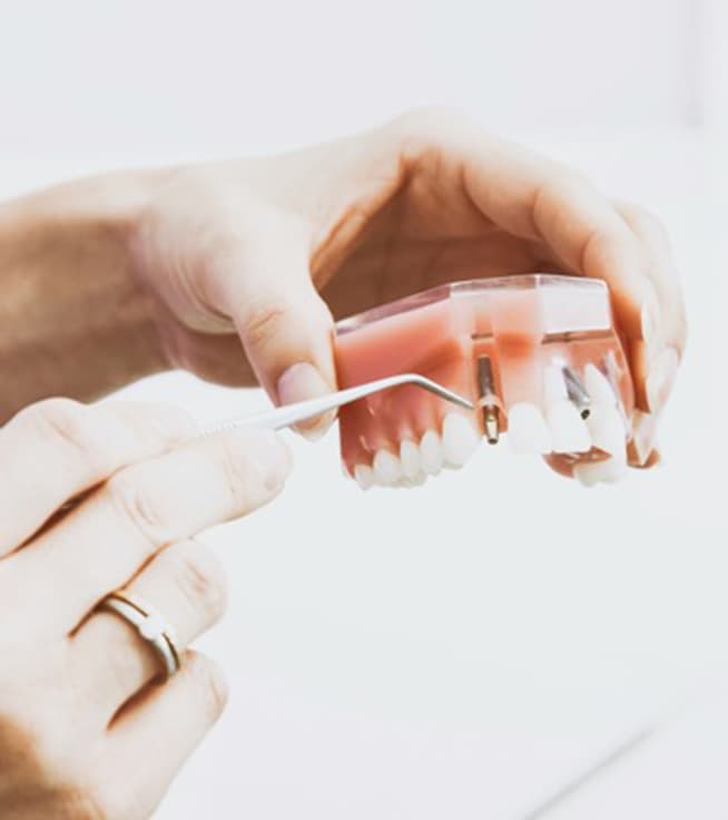 Dental Implants: Your Permanent Solution for Missing Teeth