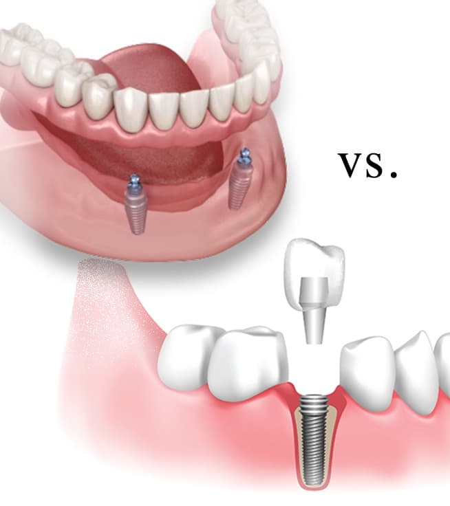 Permanent vs. Removable Dental Implants