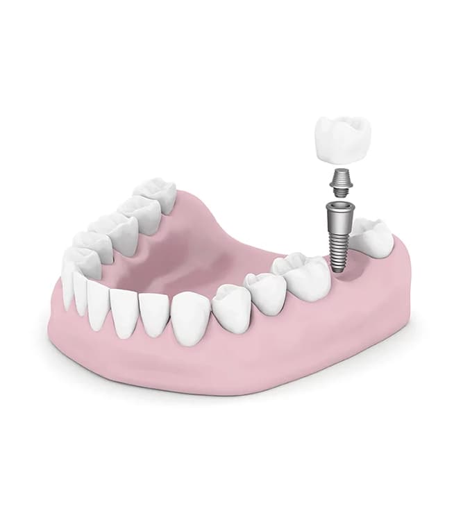 Dental Implant Aftercare: From Day One to Lifelong Success