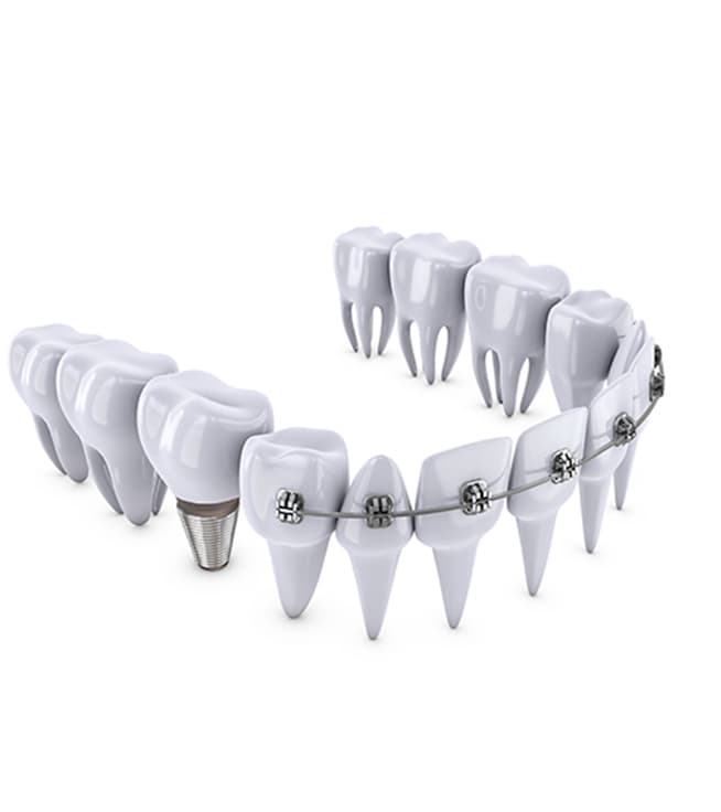 The Order of Orthodontic and Implant Treatment: Which Comes First?
