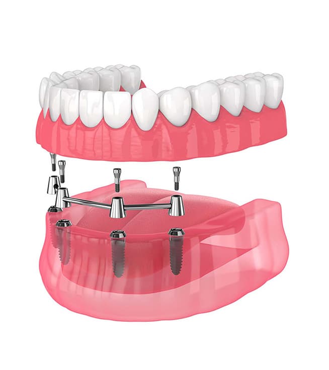 ?How Many Implants Are Needed for a Toothless Jaw