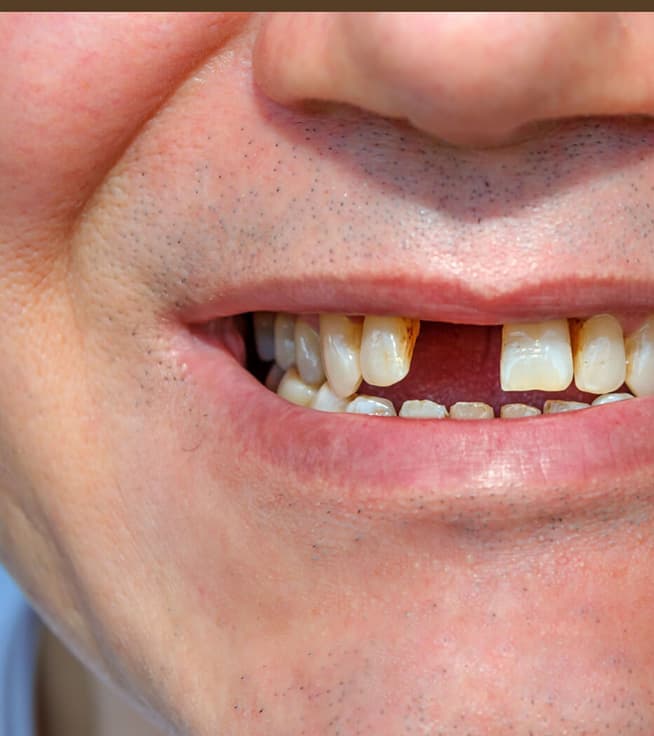 Treatment Options for Missing Teeth
