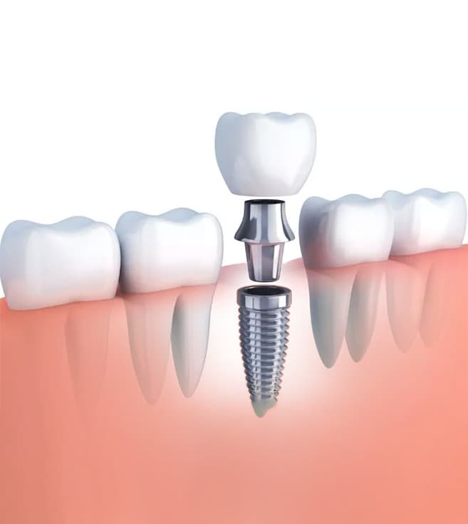 Dental Implant Procedure: Step-by-Step Guide