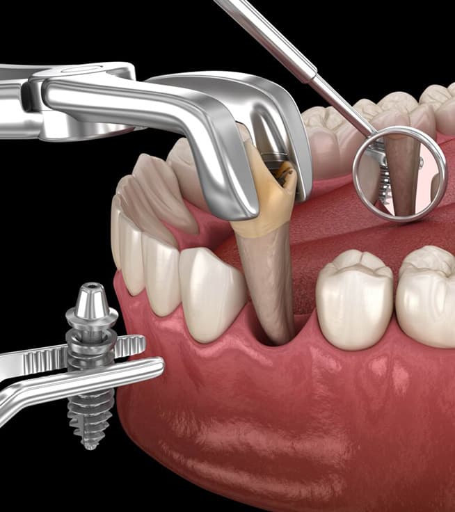 Steps from Tooth Extraction to Dental Implant Placement