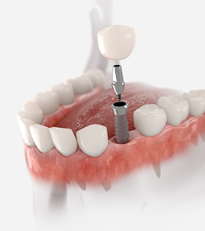 What Happens If a Dental Implant Is Not Done in Time?