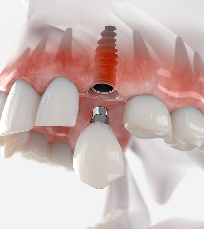 Can Dental Implants Cause Allergic Reactions?