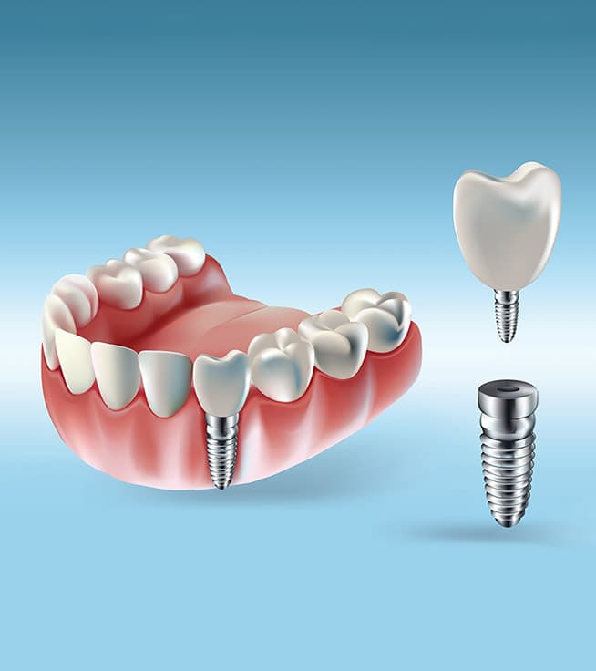 How Long Do Dental Implants Last?