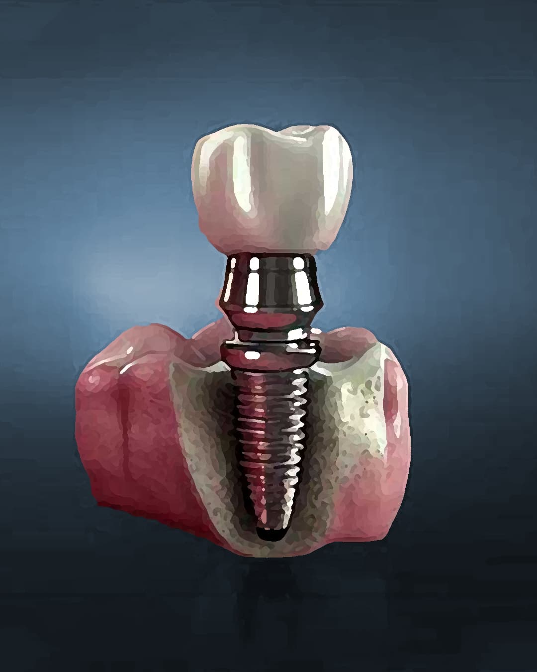 Immediate vs Conventional Dental Implants: Which Option Is Better?