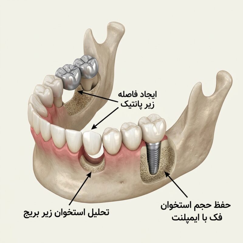 تحلیل استخوان فک در زیر دندان معلق بریج
