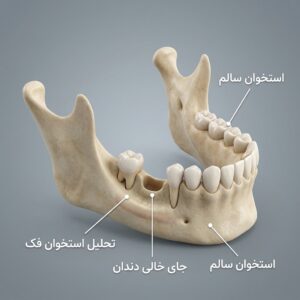 تحلیل استخوان فک ناشی از جای خالی دندان